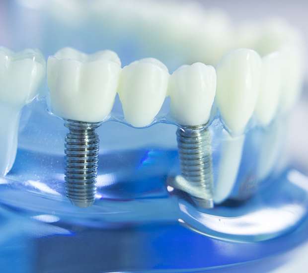Hutto Dental Implants