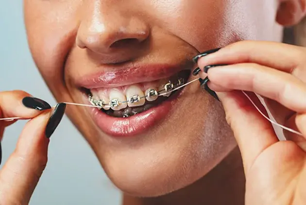 Close-up of a patient displaying clear braces on their teeth while smiling.