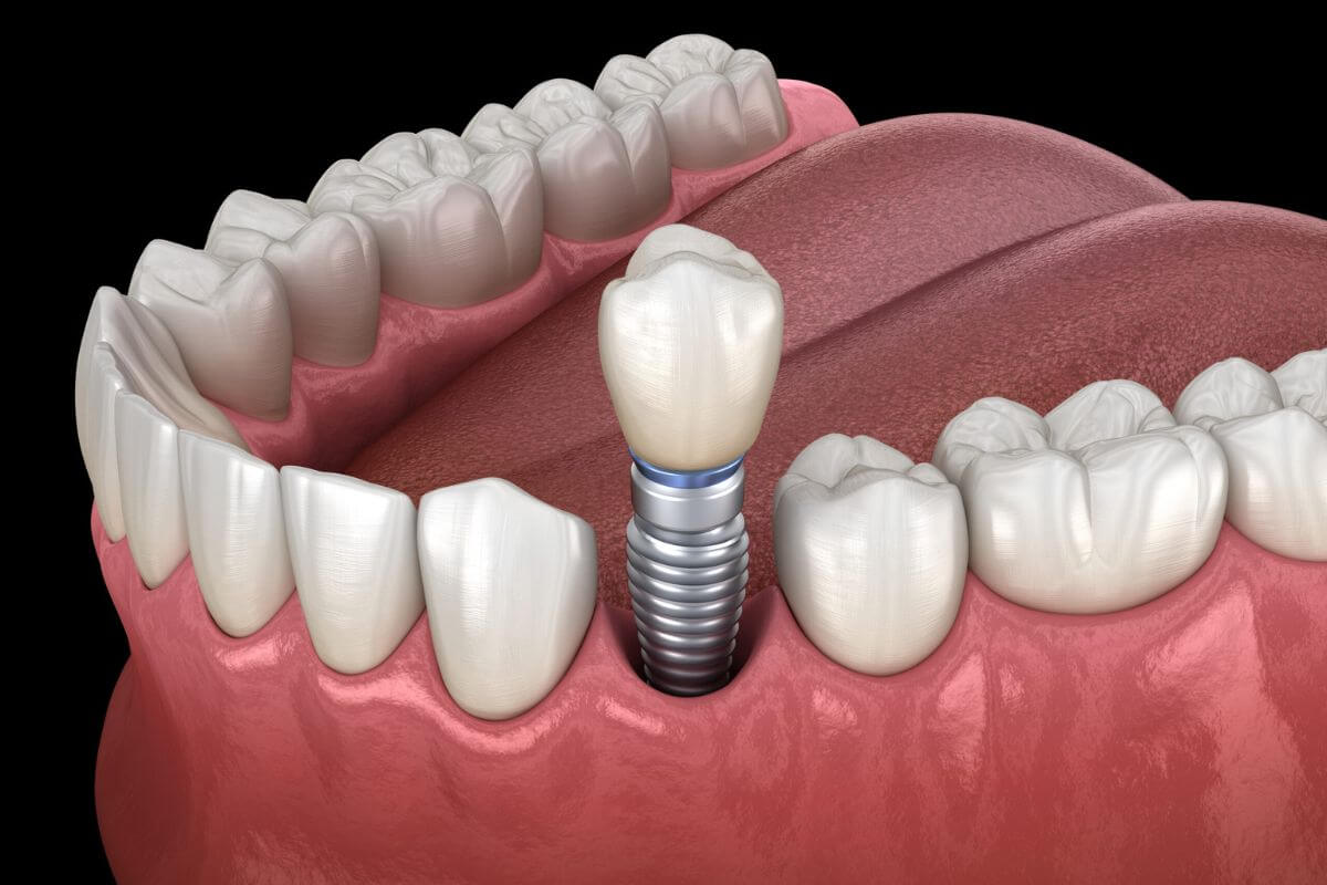 dental implants structure on model teeth structure