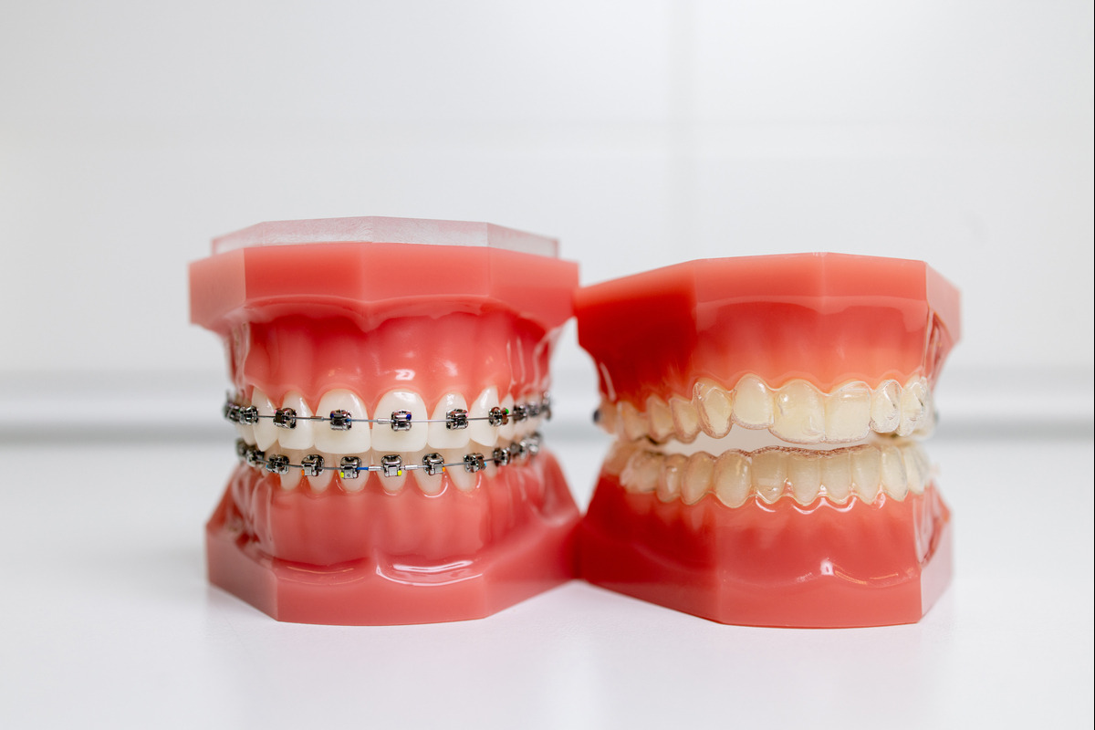 Invisalign Treatment Hutto