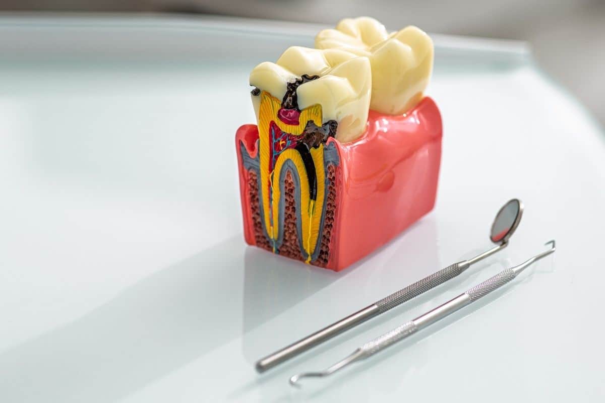 Root Canal Treatment Hutto