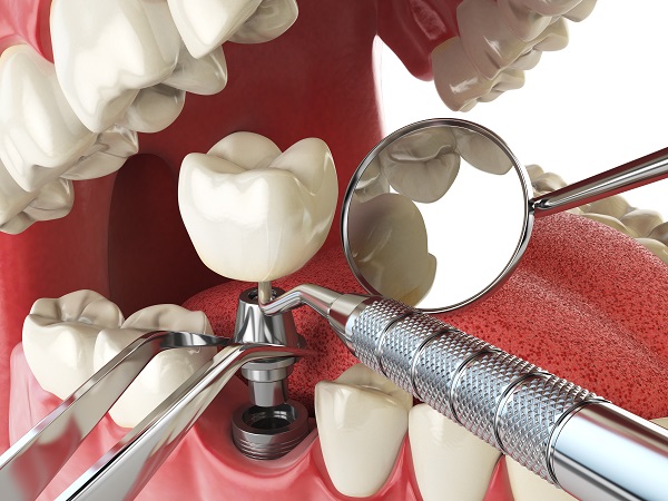 dental implant restoration Hutto, TX